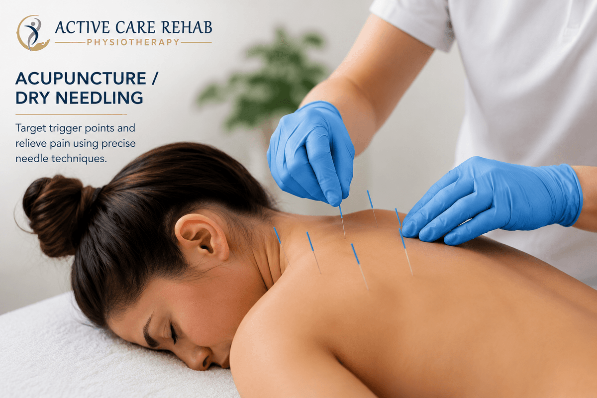 Acupuncture Dry Needling